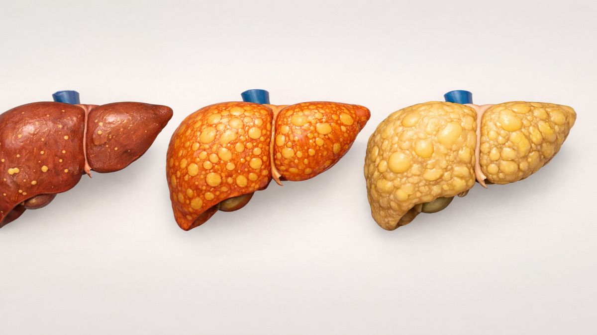 जानिये कितना खतरनाक है फैटी लिवर? 90% लोग यह गलती कर रहे हैं 4 fatty liver stages grade 1 grade 2 grade 3 explained